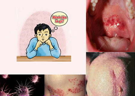 Bệnh lậu là căn bệnh nguy hiểm
