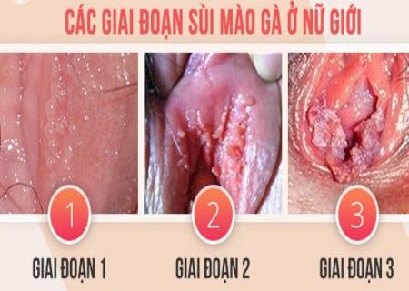 Bệnh sùi mào gà là căn bệnh có tốc độ lây lan nhanh chóng