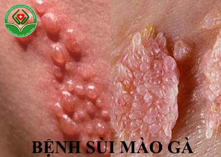 bệnh sùi mào gà là gì bệnh sùi mào gà là gì