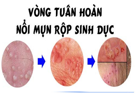 Triệu chứng mụn rộp sinh dục qua các giai đoạn