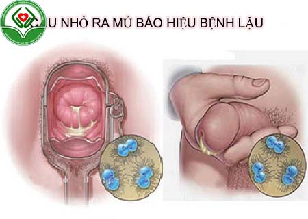 cậu nhỏ ra mủ