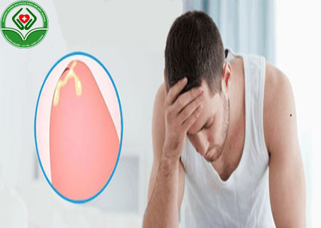 Chi phí điều trị dương vật chảy mủ hiệu quả