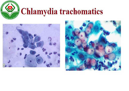 Kết quả xét nghiệm Chlamydia dương tính có ý nghĩa gì?