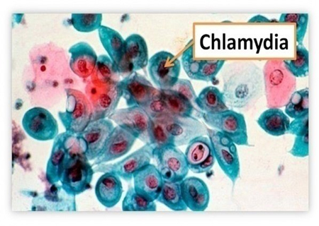 Vi khuẩn gây bệnh Chlaymydia nguy hiểm