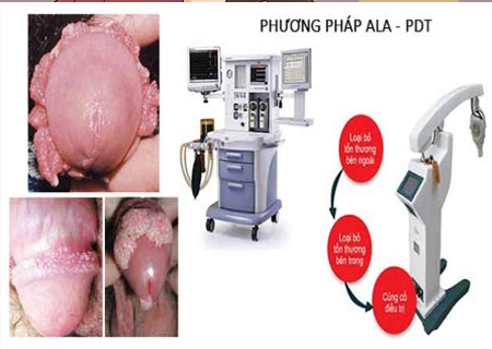 Điều trị sùi mào gà bằng phương pháp ALA-PDT