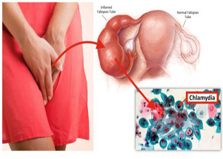 chlamydia là gì chlamydia là gì