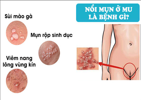 Có nhiều nguyên nhân nổi mụn lông mu mà người bệnh cần lưu ý