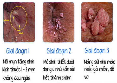 Dấu hiệu sùi mào gà hậu môn thay đổi theo từng giai đoạn