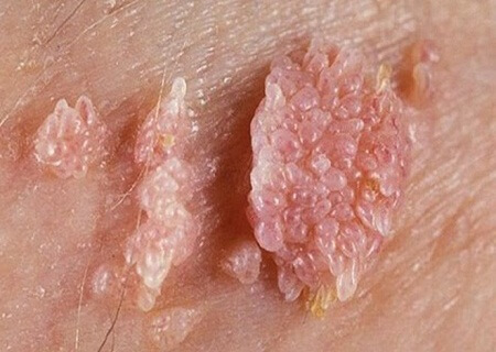 Mụn sùi mào gà mọc như thế nào Mụn sùi mào gà mọc như thế nào