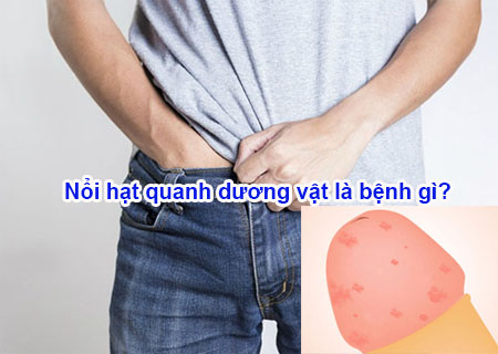 Nổi hạt quanh dương vật là tình trạng của bệnh gì