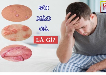 Sùi mào gà lây qua nhiều con đường và nhiễm bệnh nhanh chóng 