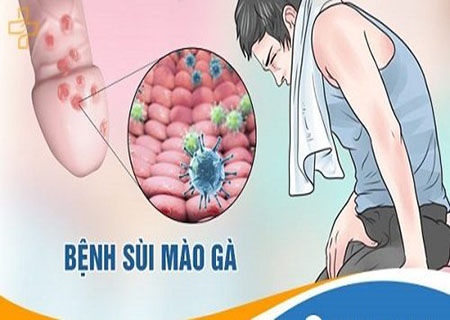 dấu hiệu sùi mào gà ở nam giới