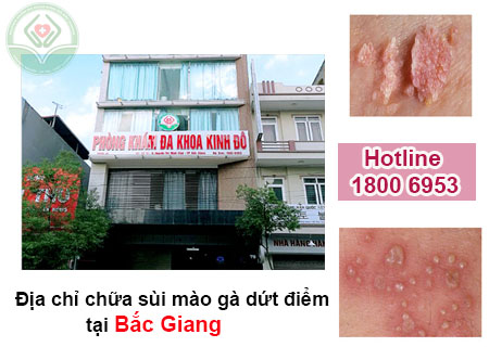 Địa chỉ chữa sùi mào gà ở Bắc Giang uy tín