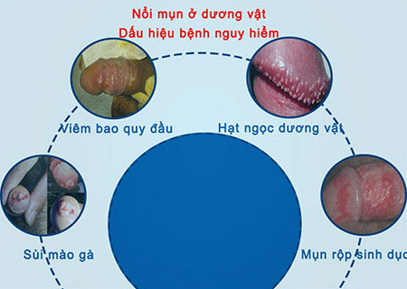 dương vật nổi mẩn ngứa