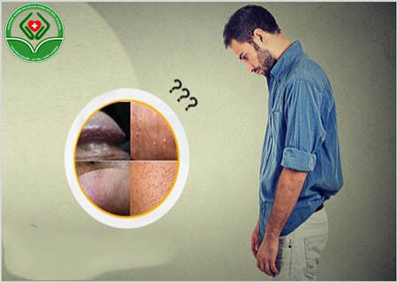Nổi hạt quanh dương vật là tình trạng của bệnh gì