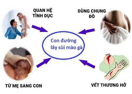 nữ bị sùi mào gà có lây không