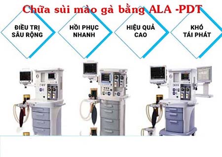 Phương pháp ALA-PDT chữa bệnh sùi mào gà hiệu quả