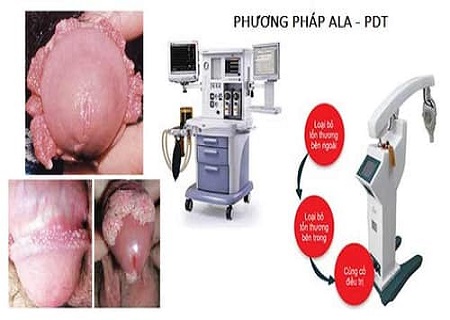 P;hương pháp ALA-PDT điều trị sùi mào gà hiệu quả