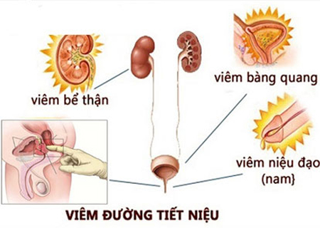 Viêm đường tiết niệu là căn bệnh nguy hiểm