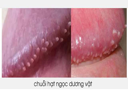 Hình ảnh thật bệnh chuỗi hạt ngọc dương vật