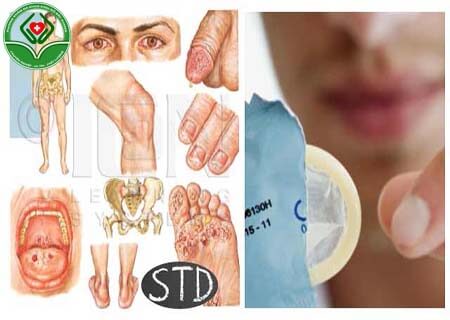 Triệu chứng của bệnh stds là gì?
