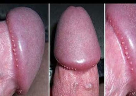 Chuỗi hạt ngọc dương vật là biểu hiện bệnh lành tính