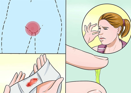Điều trị Nấm Candida ở nữ giới để khắc phục tình trạng khó chịu