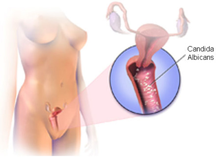 Nấm Candida ở nữ giới gây nên nhiều bệnh nguy hiểm
