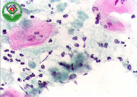 Nấm Candida gây nhiều bệnh viêm nhiễm đường sinh dục