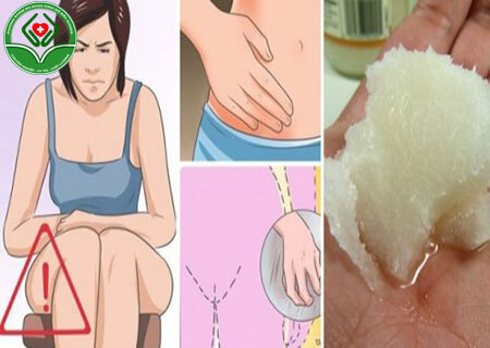 Biểu hiện nấm candida âm đạo chị em cần biết
