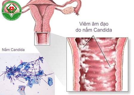 nấm Candida tồn tại và chung sống trong cơ thể người