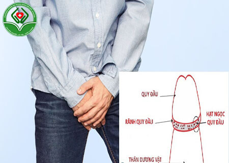 Mụn rãnh quy đầu cảnh báo nhiều bệnh lý