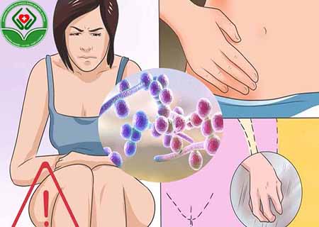 nấm candida