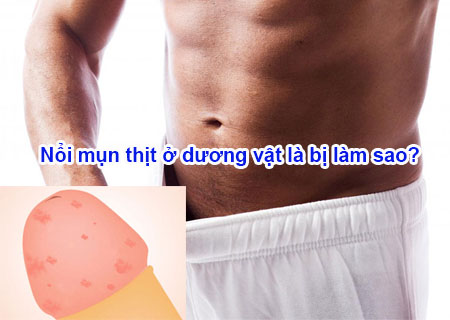 Dương vật nổi mụn thịt - dấu hiệu đáng lo ngại