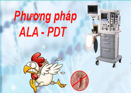 Chữa mụn cóc vùng kín hiệu quả bằng phương pháp ALA - PDT