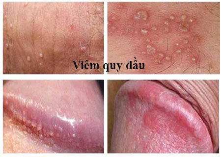 Mụn rãnh quy đầu do bệnh viêm quy đầu