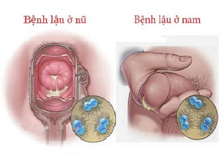 Bệnh lậu la căn bệnh lây nhiễm nguy hiểm