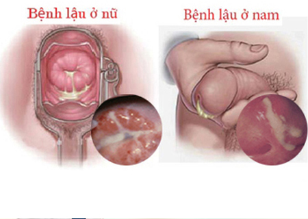 Bệnh lậu dễ dàng lây nhiễm qua quan hệ tình dục không an toàn