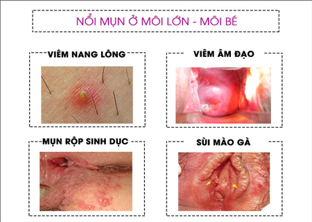 Âm đạo mọc mụn thịt là dấu hiệu cảnh báo nhiều bệnh nguy hiểm