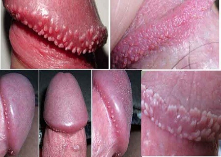Ranh-bao-quy-dau-noi-hat-nho-la-dau-hieu-cua-benh-gi