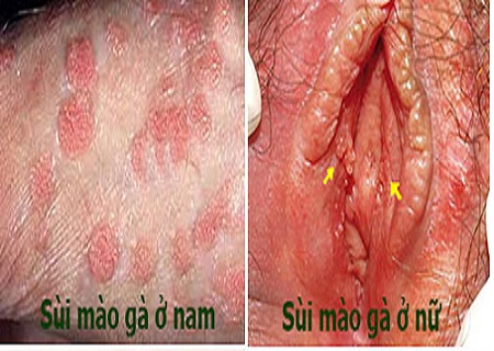 Hình dạng sùi mào gà tại bộ phận sinh dục