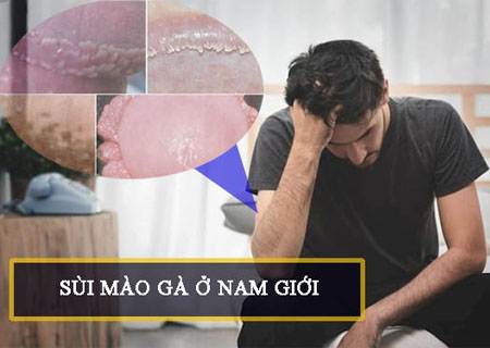 Bệnh sùi mào gà ở nam giới