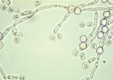 Phác đồ điều trị bị nấm Candida có thực sự hiệu quả hay không? - Chữa ...