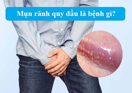 Mụn rãnh quy đầu là bệnh gì