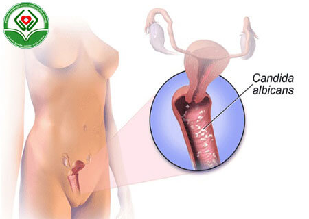 Nấm Candida tái phát