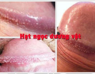 Những điều cần biết về chuỗi hạt ngọc dương vật