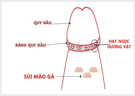 biểu hiện chuỗi hạt ngọc dương vật