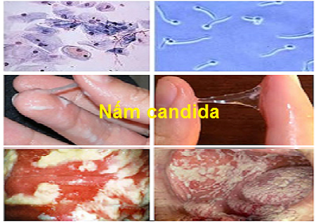 biểu hiện nấm candida ở nữ giới - Chữa Bệnh Xã Hội Bắc Giang